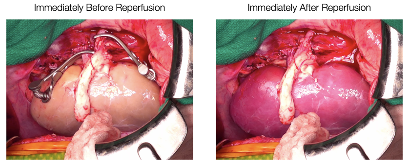 Supercooled kidneys have been transplanted into pigs in a “landmark achievement” 图片 1