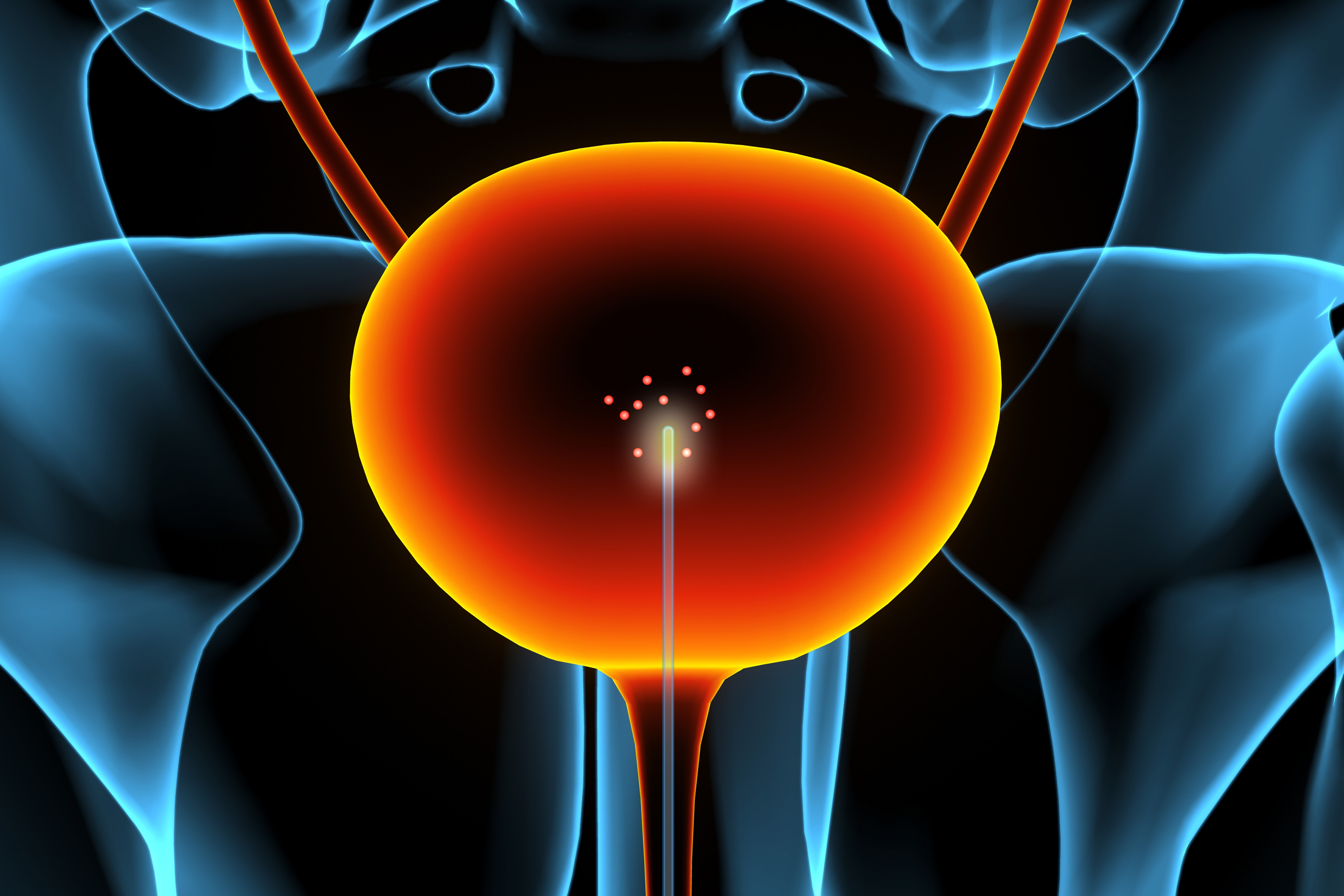 A new sensor could enable earlier detection of bladder cancer 图片 1