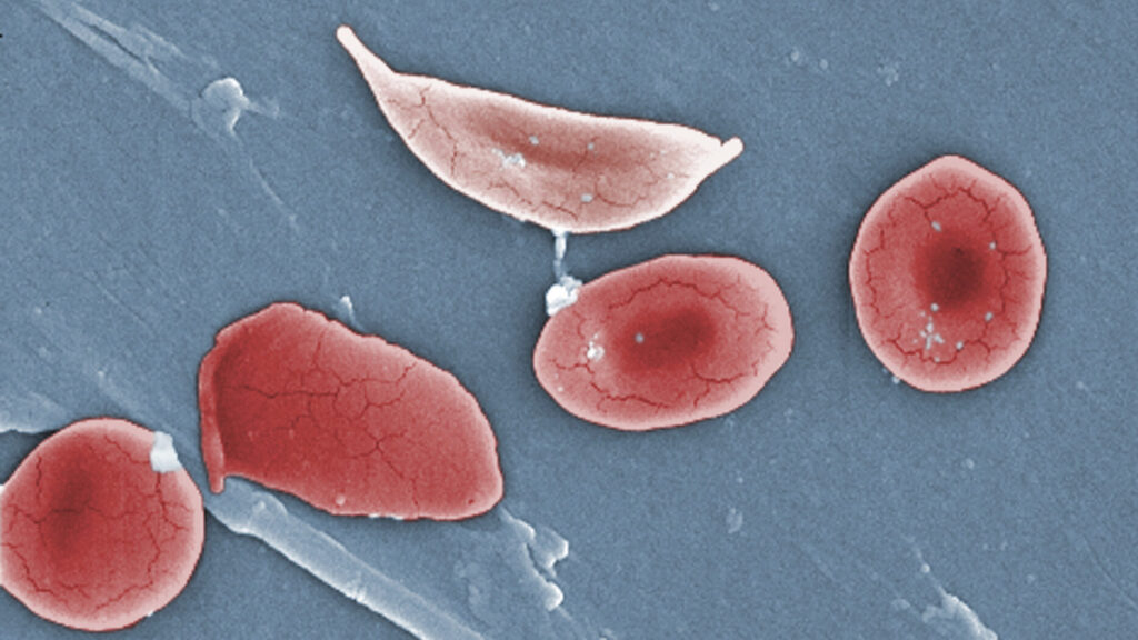 Vertex's CRISPR treatment for sickle cell disease hits unexpected roadblock 图片 1