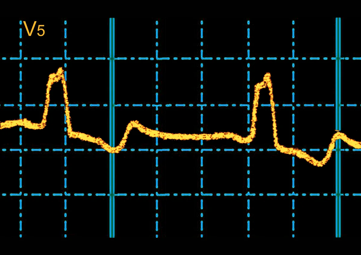 AI finds hidden ECG signal that predicts sudden cardiac death risk 图片 1