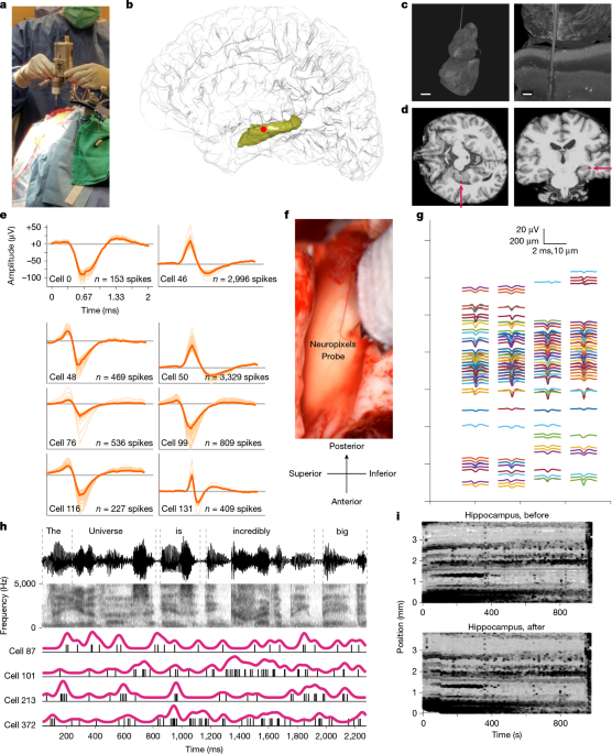 Plasticity and language in the anaesthetized living human hippocampus 图片 1