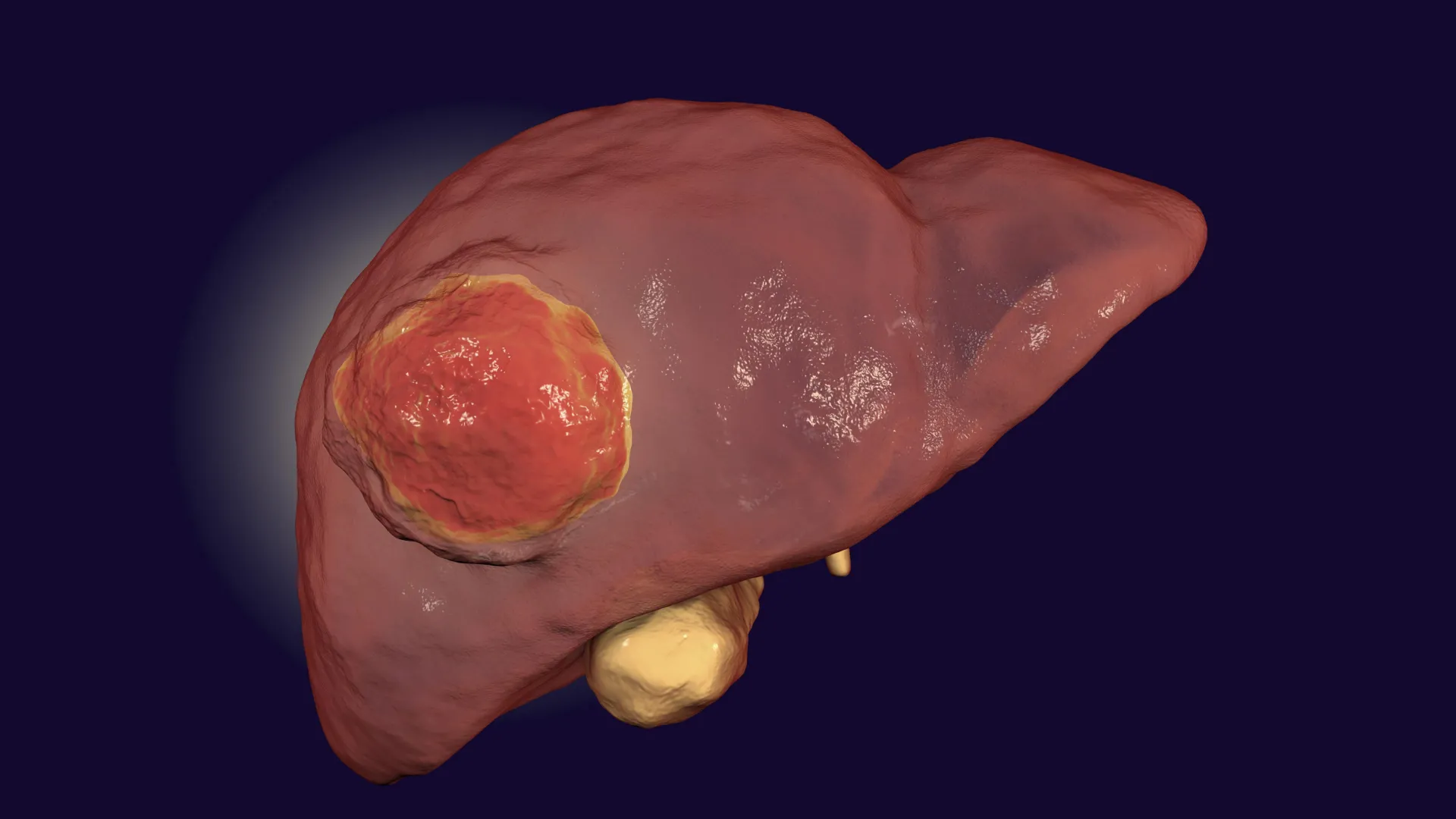 FDA-approved drug may finally help immunotherapy defeat rare liver cancer 图片 1