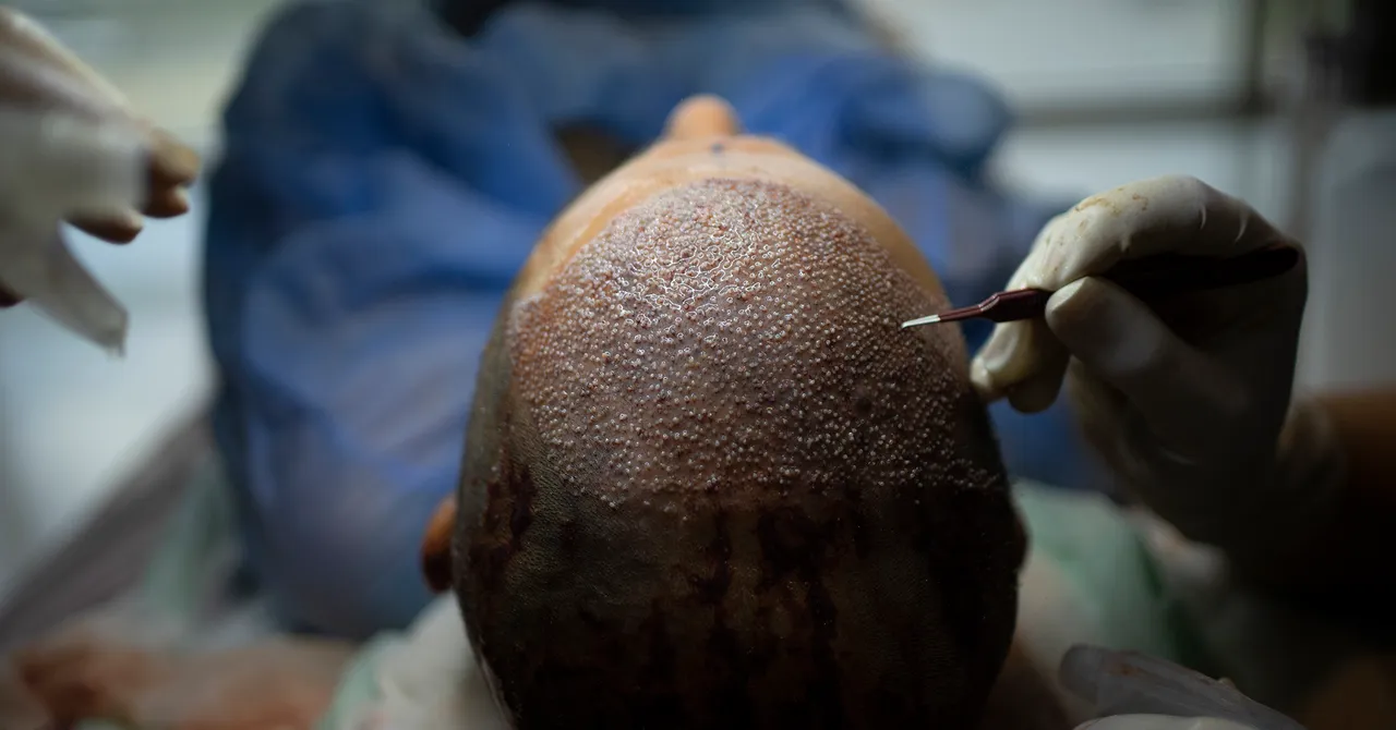 Turkey Hacked the Hair Transplant Industry 图片 1