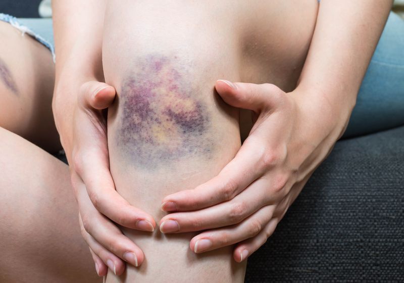What makes bruises change color over time 图片 1