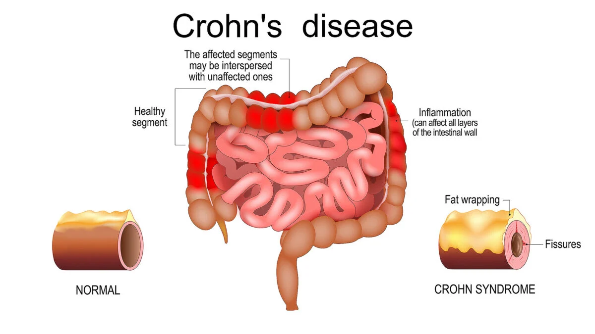 Inflammatory Bowel Disease Has Been Recreated on a Chip, And Scientists Could Finally Figure Out Its Cause 图片 2