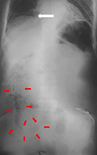 A Patient With a Perforated Bowel Shows Why Eels Shouldn't Be Anywhere Near Your Butt 图片 2