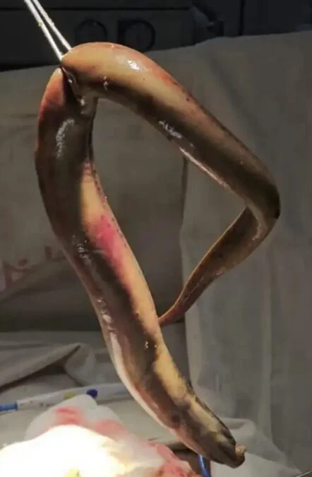 A Patient With a Perforated Bowel Shows Why Eels Shouldn't Be Anywhere Near Your Butt 图片 3